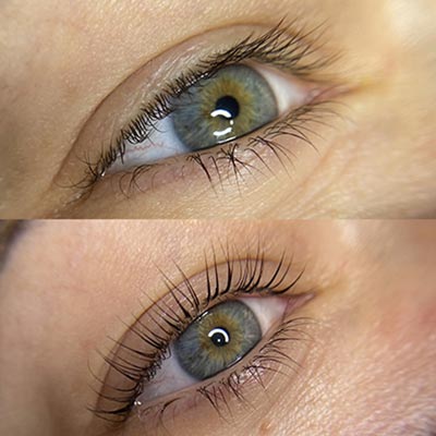 The Ultimate Guide to Eyelid Surgery in Halifax, Canada