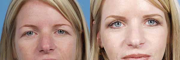 Eyelid Surgery Halifax