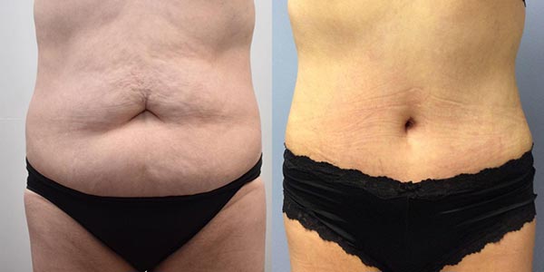 Tummy Tuck vs Panniculectomy - Halifax, NS - Prince Edward Island